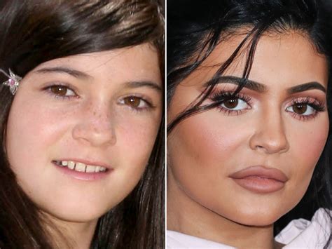 Kylie Jenner Before and After: From 2008 to 2022